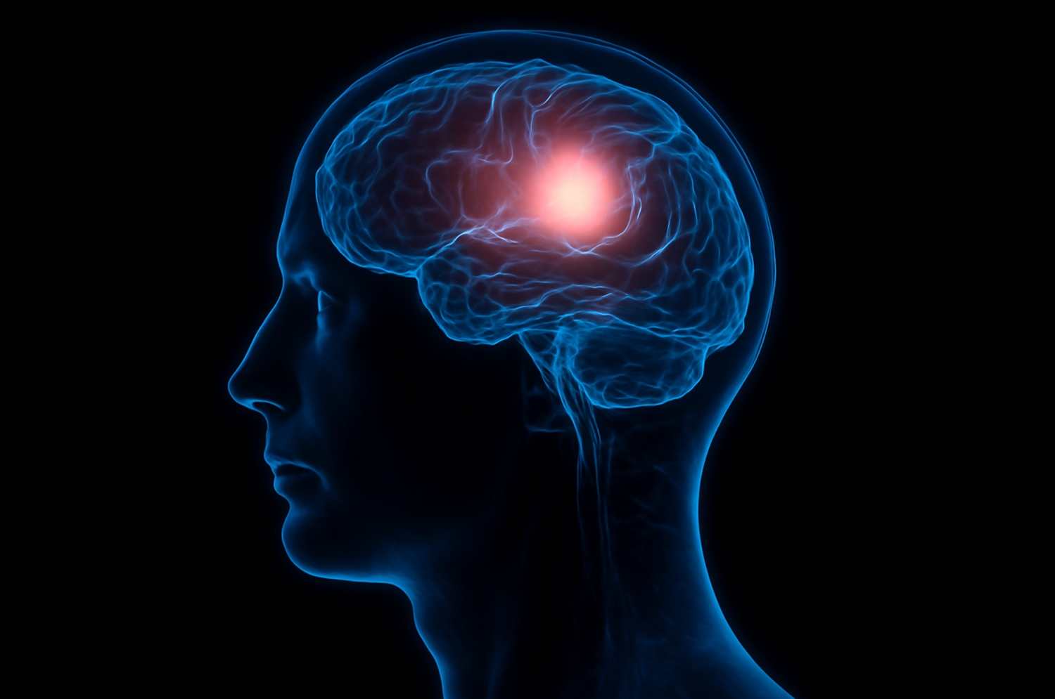 costom brain implant